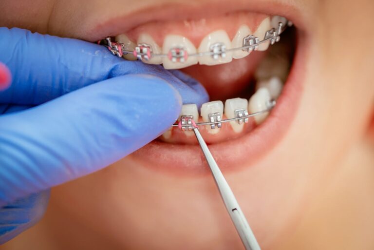 Braces & Aligners