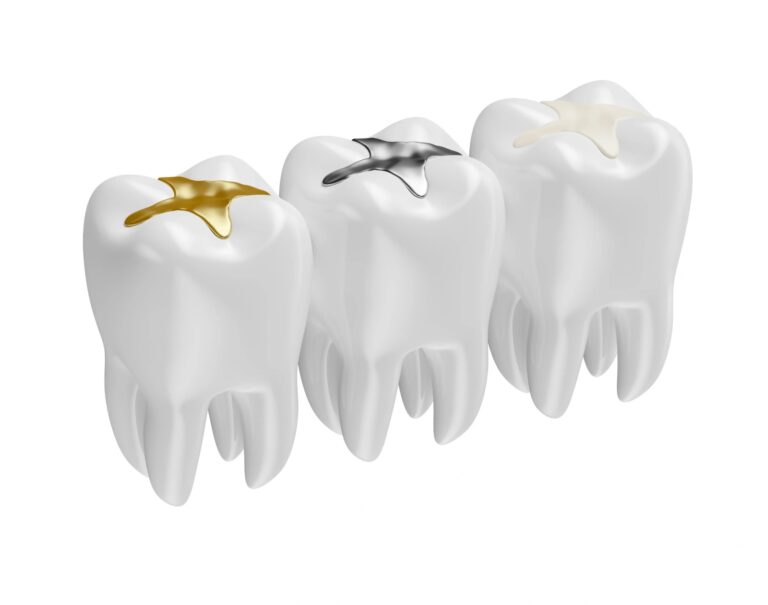 Tooth Filling